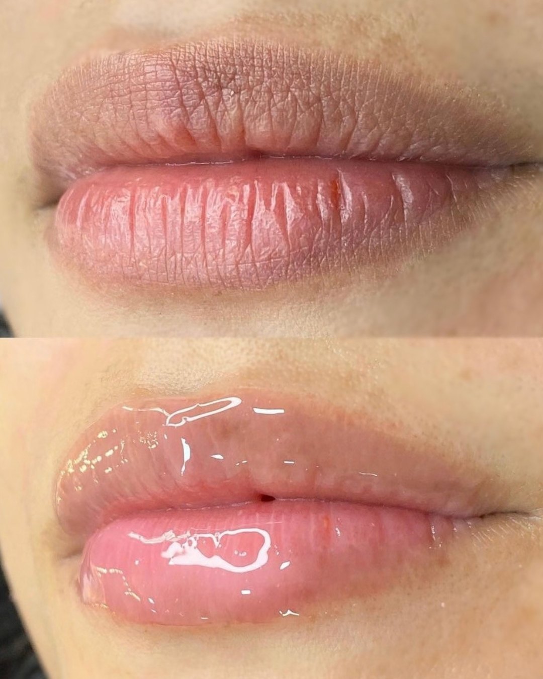 Lábios antes e depois do procedimento