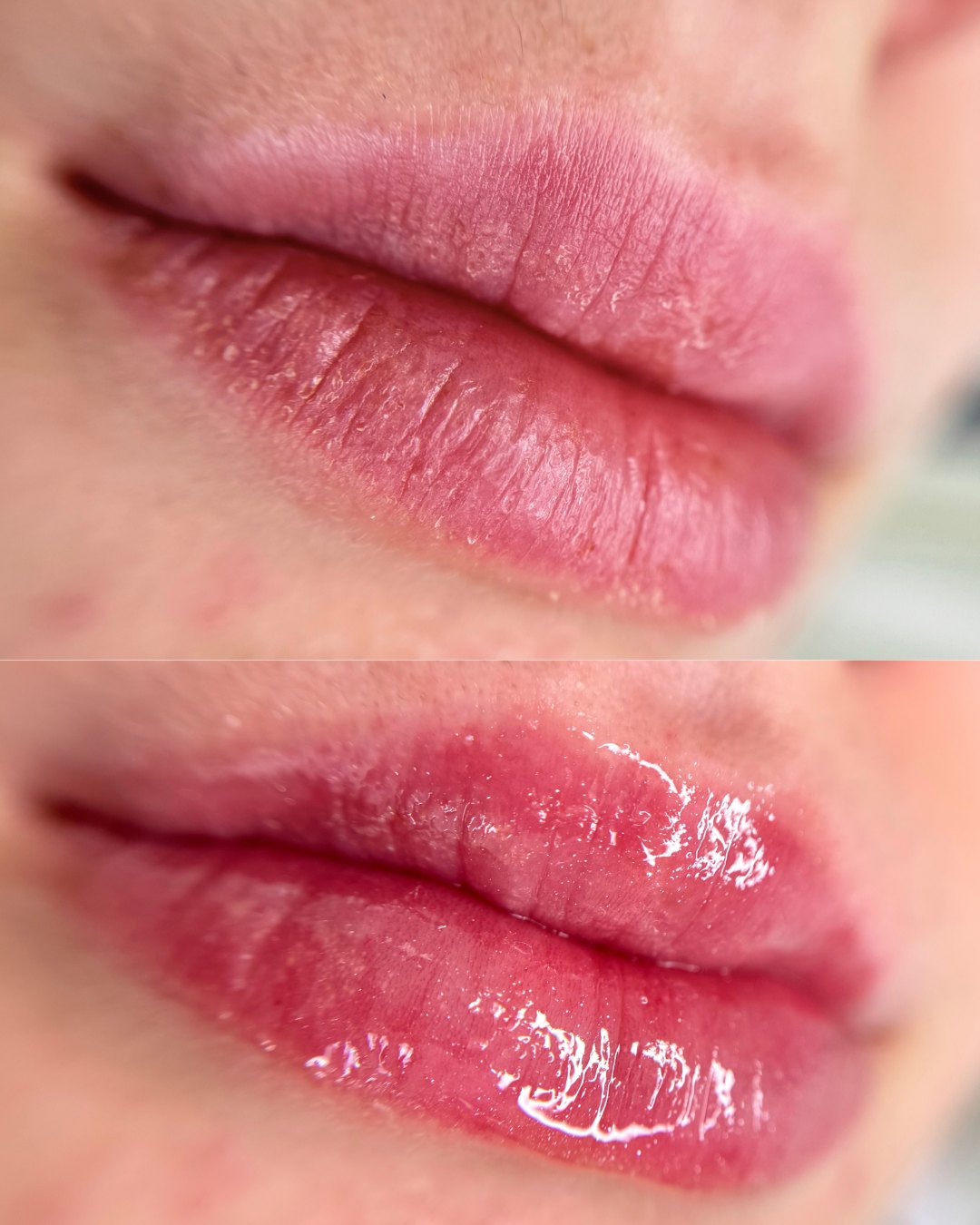 Lábios antes e depois do procedimento