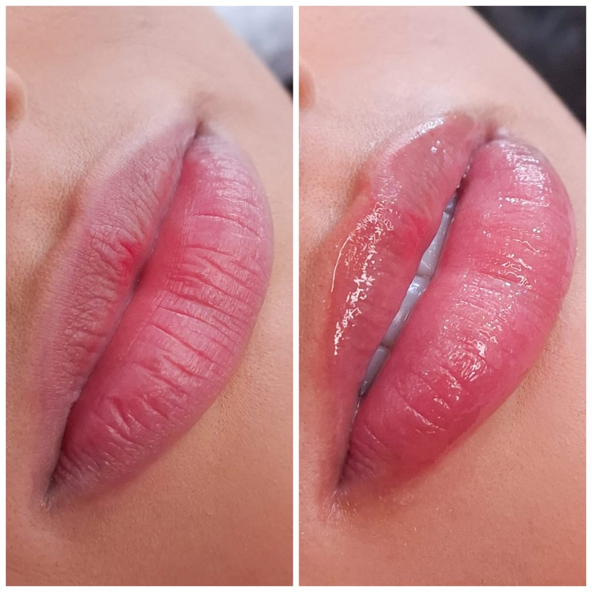 Lábios antes e depois do Hydra Gloss