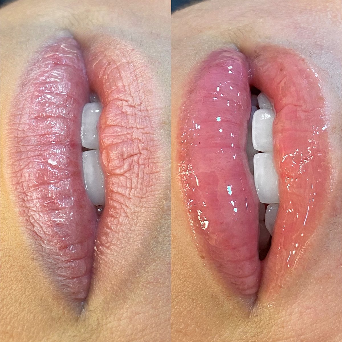 Lábios antes e depois do Hydra Gloss