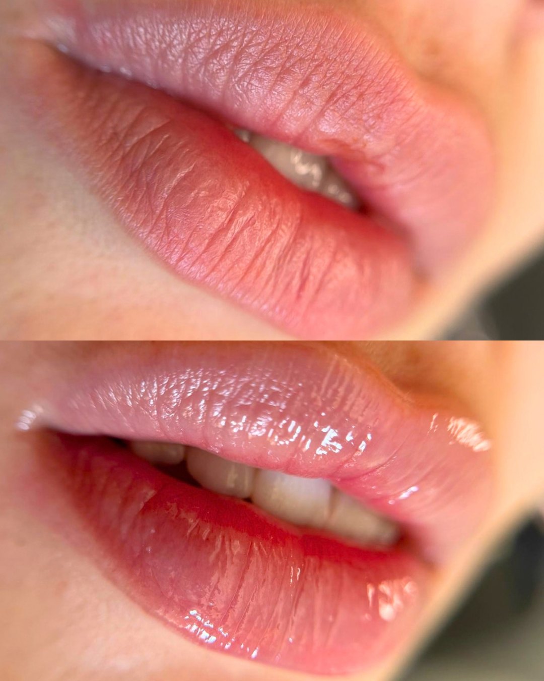Lábios antes e depois do Hydra Gloss