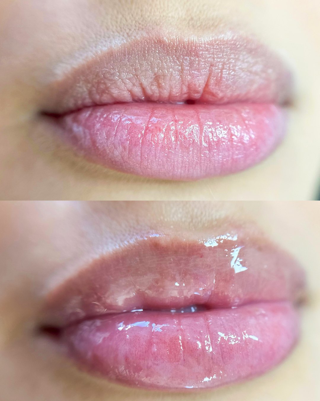 Lábios antes e depois do Hydra Gloss