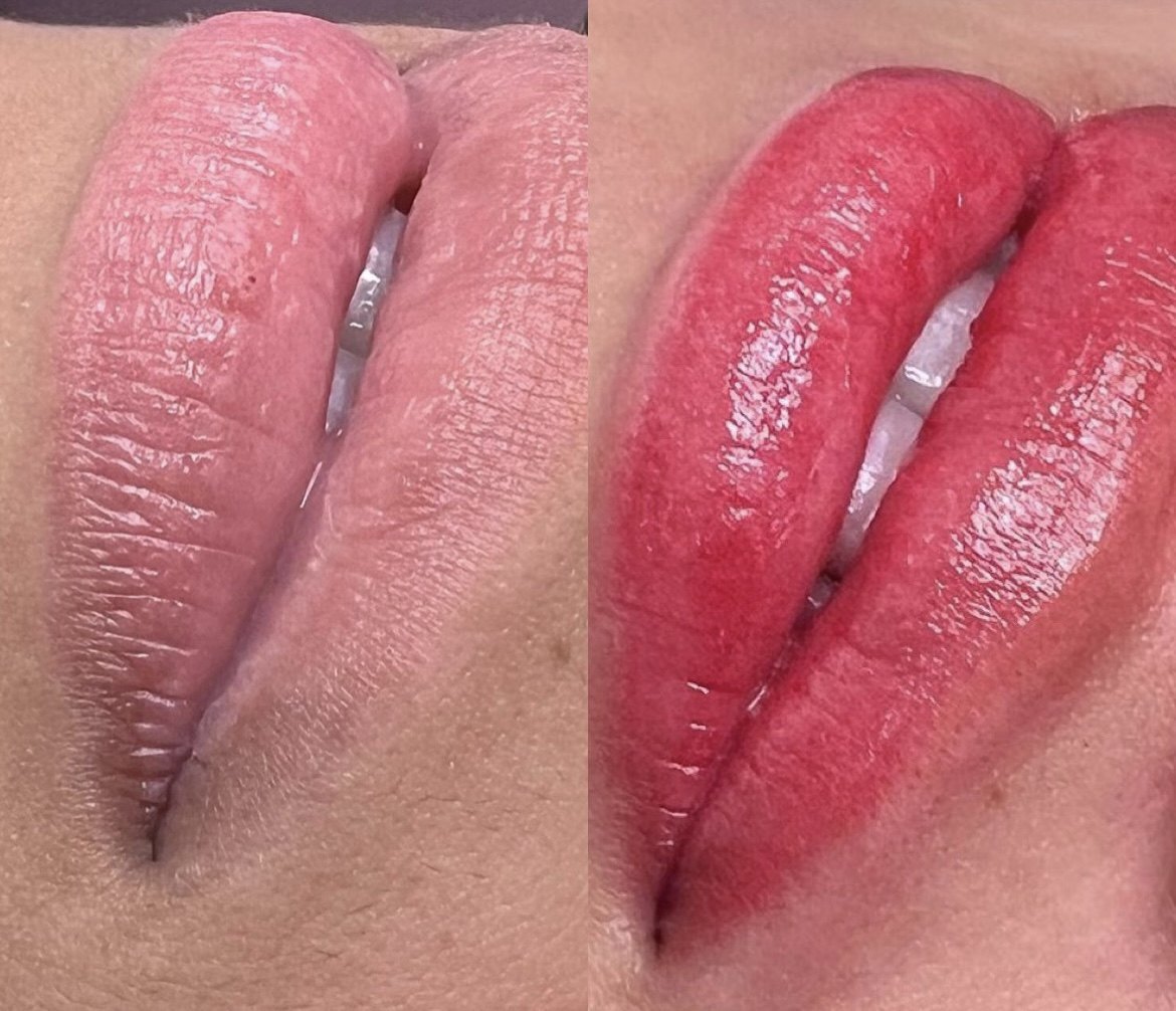 Lábios antes e depois do procedimento