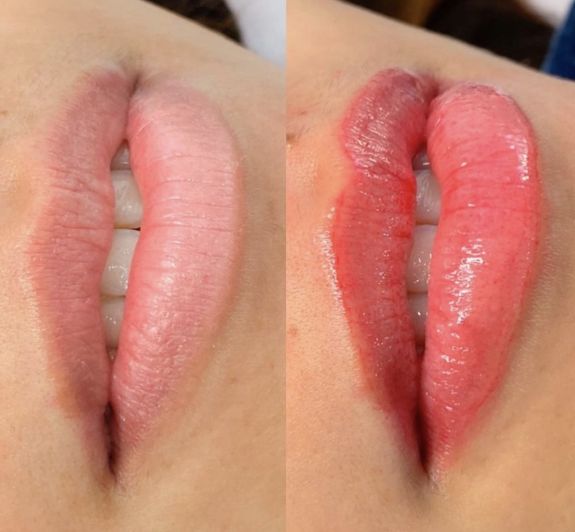 Lábios antes e depois do procedimento