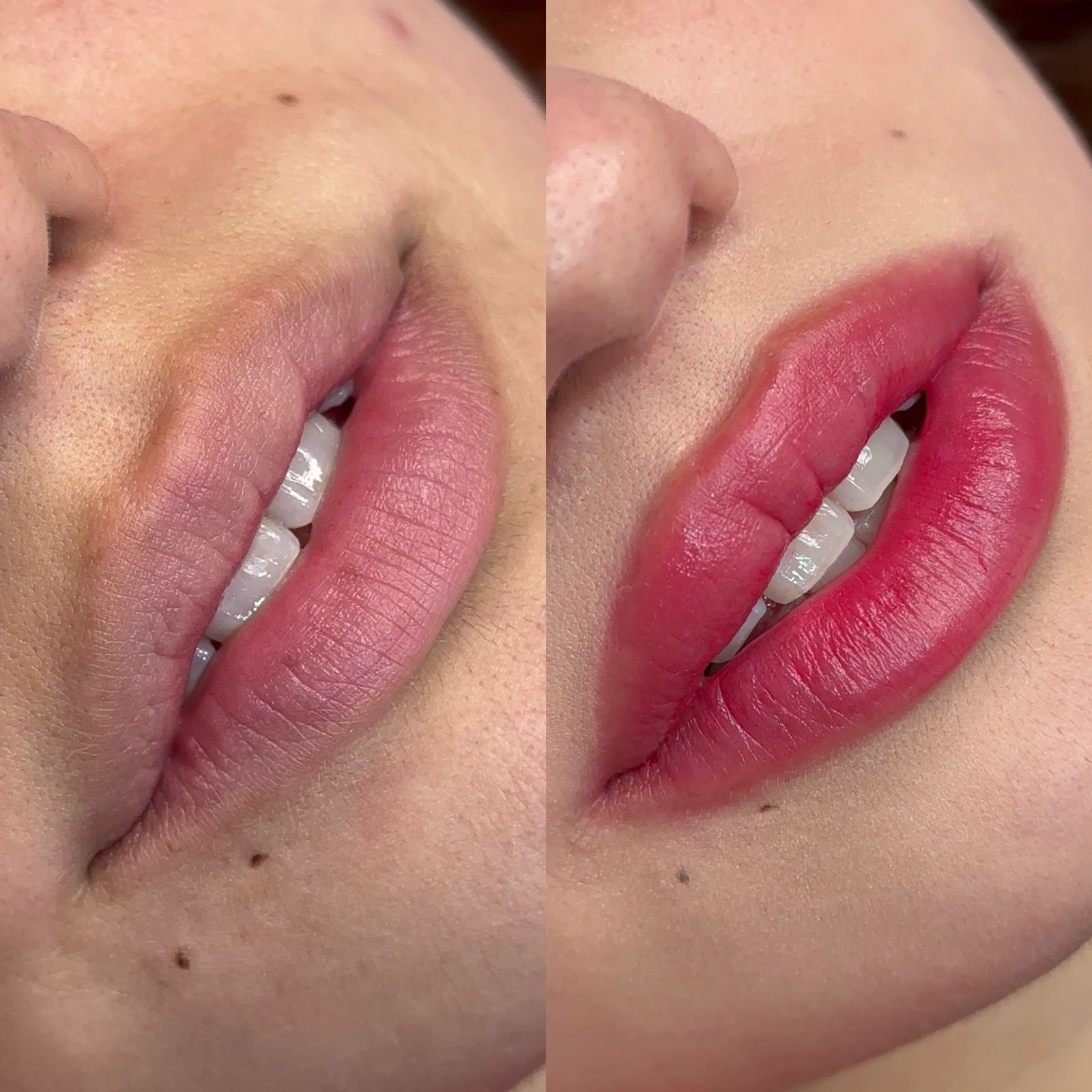 Lábios antes e depois do procedimento