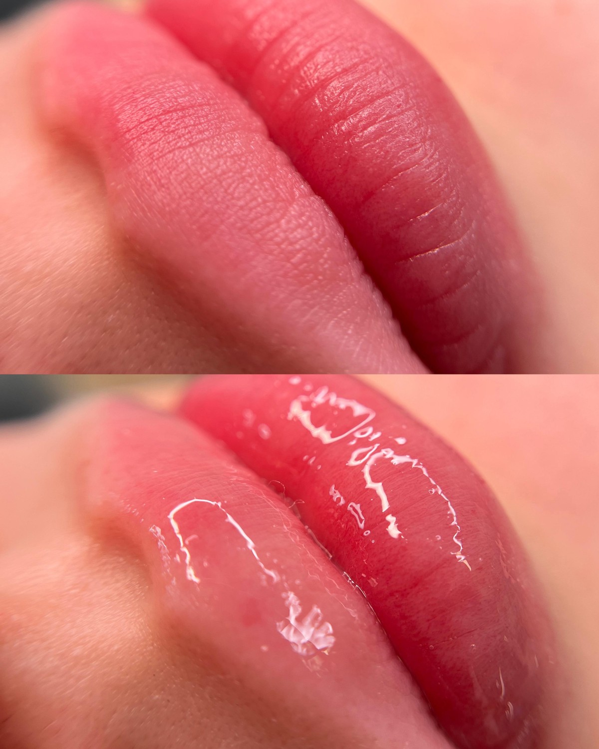 Lábios antes e depois do protocolo Hydra Gloss com Nano Therapy