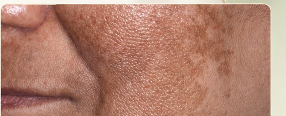 Melasma