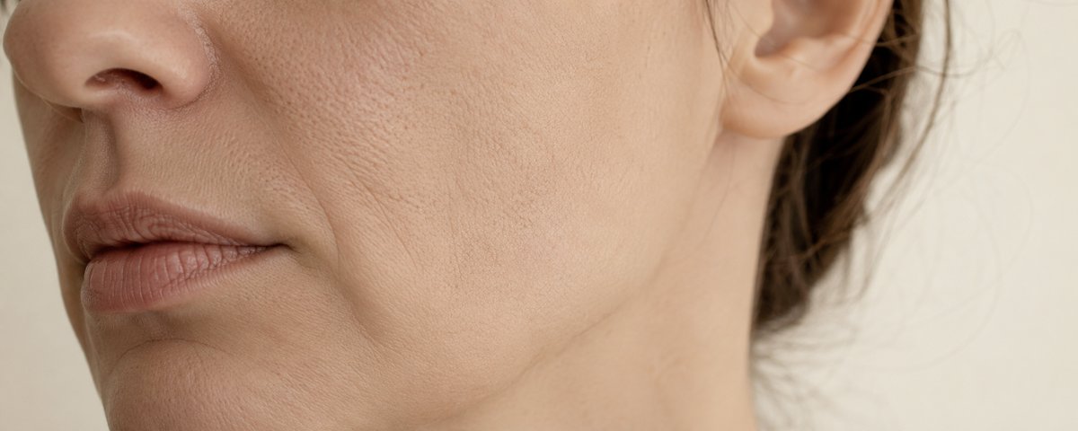 Opacidad facial y falta de luminosidad