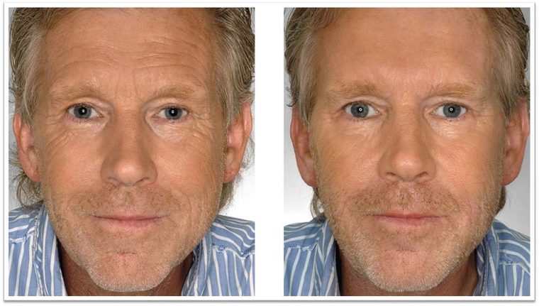 Julián Anaragua, antes y después de cinco meses